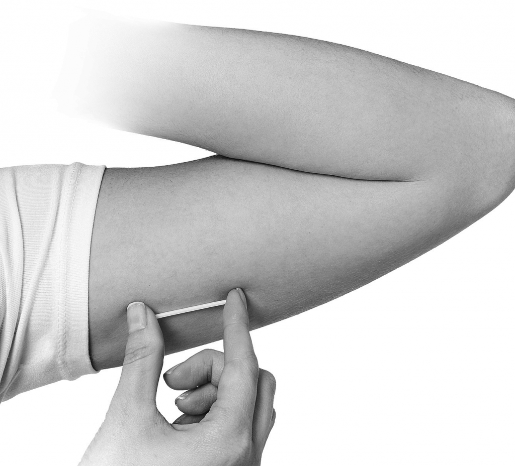 Zemādas implants 
ir četrus centimetrus garš implants, ko ārsts ievada zem ādas augšdelma iekšpusē.

Autors: mariestopes.org.za